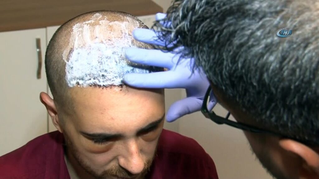 Antalya saç ekimi uygulamaları