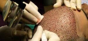 Antalya saç ekimi uygulamaları