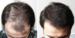 Saç ekimi sonrasında yaşananlar