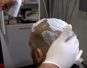 Saç ekiminden sonra yapılacaklar